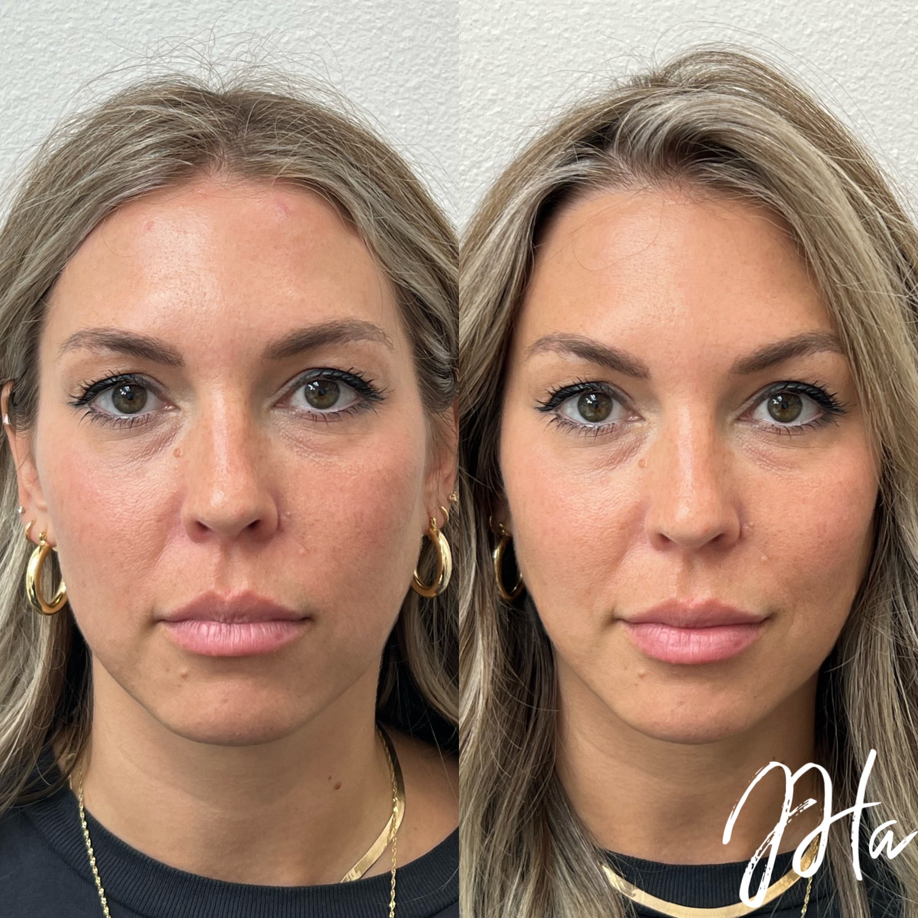 Before and after of facial injection results