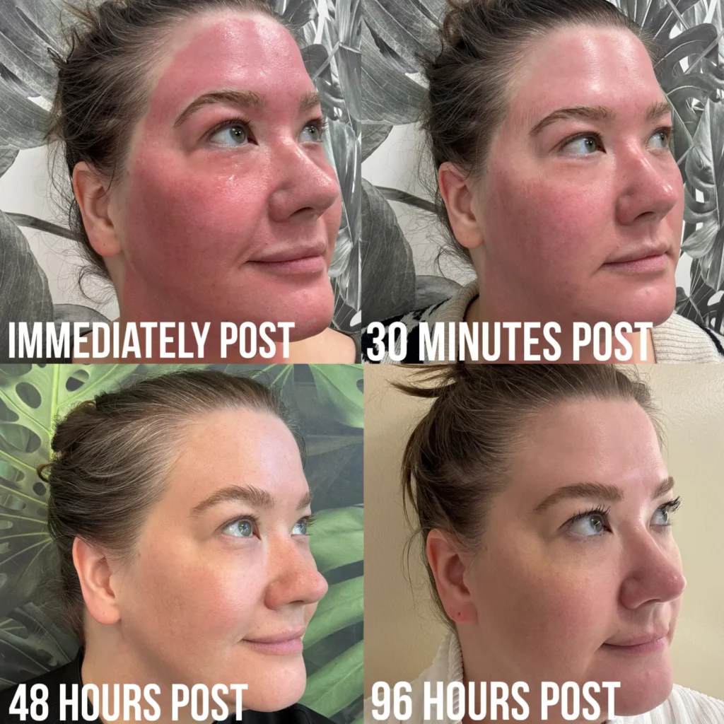 Microneedling-Journey-Jenny - Skin Synthesis