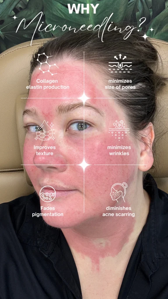 Why-Microneedling-Jenny - Skin Synthesis